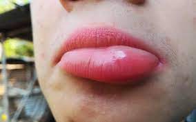 Enlarged Lips – Causes and Homeopathic Treatment-Life Homeo Care