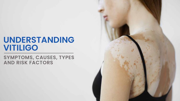 What is Vitiligo? Life Homeo Care Clinic & scene care center